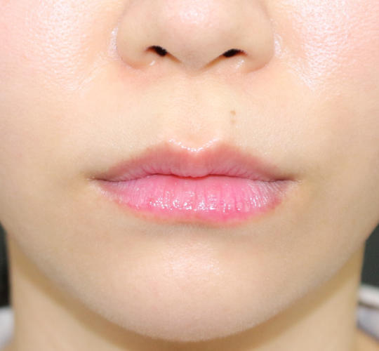 唇 口元の整形の症例写真 公式 オザキクリニック 美容整形 美容外科 美容皮膚科 東京新宿 目黒祐天寺 羽村 唇 口元の整形の症例写真 公式 オザキクリニック 美容整形 美容外科 美容皮膚科 東京新宿 目黒祐天寺 羽村