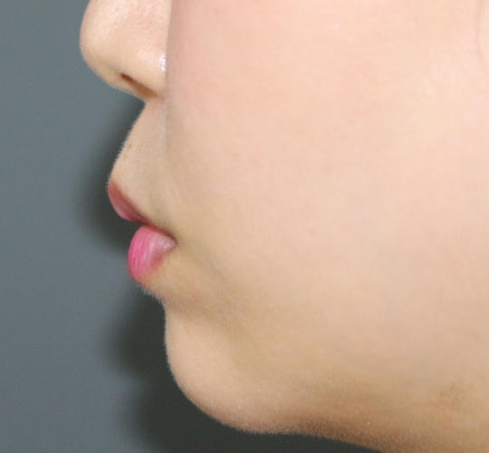 30代女性の人中短縮ボトックス After 症例写真