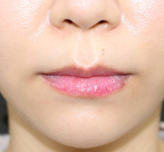 30代女性の人中短縮ボトックス Before 症例写真