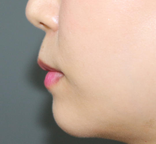 30代女性の人中短縮ボトックス Before 症例写真