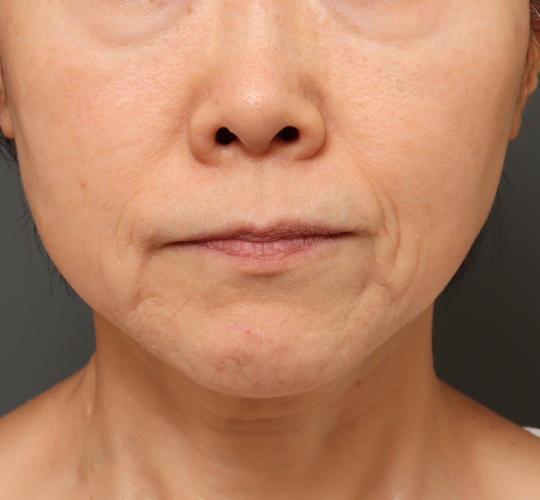 60代女性のグロウHIFUセレクトプラス After 症例写真