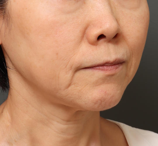 60代女性のグロウHIFUセレクトプラス After 症例写真
