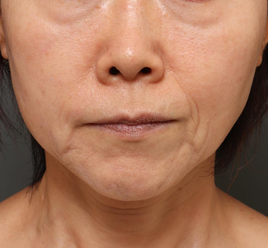 60代女性のグロウHIFUセレクトプラス Before 症例写真