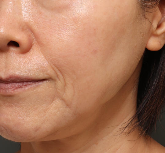 60代女性のシミ・そばかす Before 症例写真