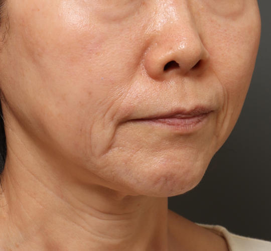 60代女性のグロウHIFUセレクトプラス Before 症例写真