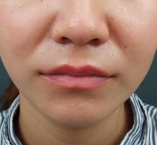 20代女性の人中短縮ボトックス After 症例写真