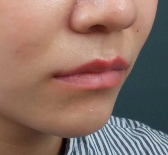 20代女性の人中短縮ボトックス After 症例写真