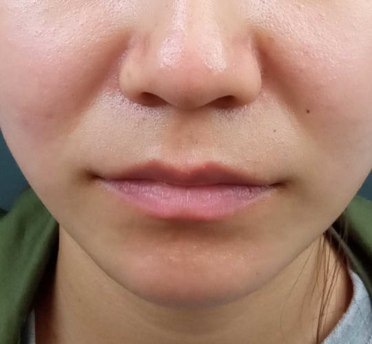 20代女性の人中短縮ボトックス Before 症例写真