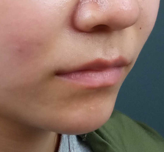 20代女性の人中短縮ボトックス Before 症例写真