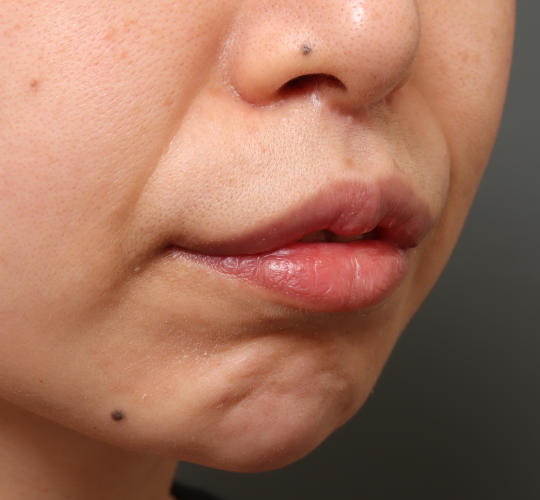30代女性のM字リップ形成 After 症例写真