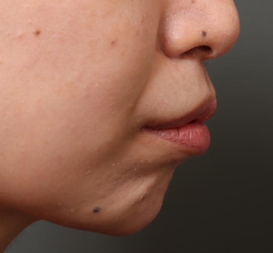 30代女性のM字リップ形成 After 症例写真