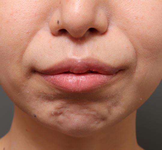 30代女性のM字リップ形成 After 症例写真