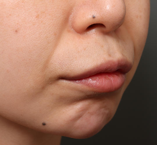30代女性のM字リップ形成 Before 症例写真