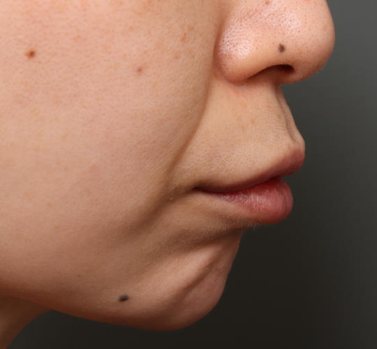 30代女性のM字リップ形成 Before 症例写真