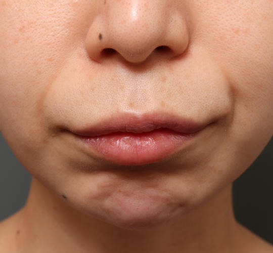 30代女性のM字リップ形成 Before 症例写真
