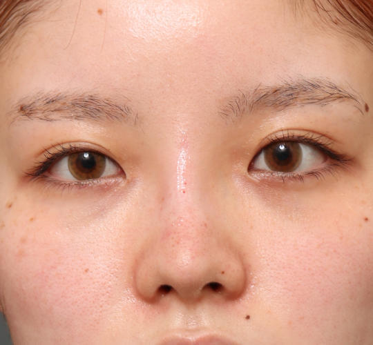 20代女性のヒアルロン酸注射(鼻形成) After 症例写真