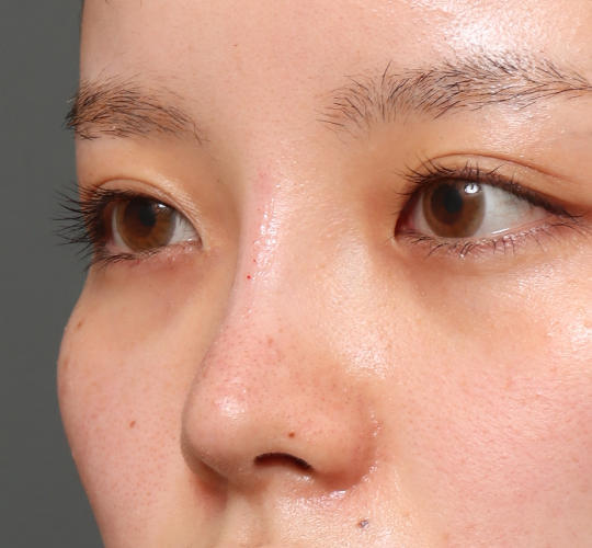 20代女性の鼻の整形 After 症例写真