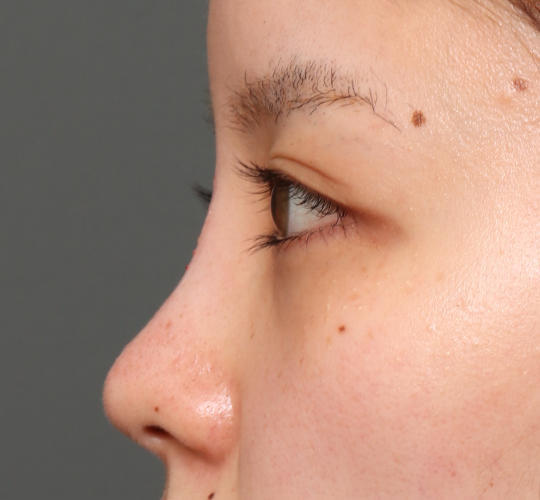 20代女性のヒアルロン酸注射(鼻形成) After 症例写真