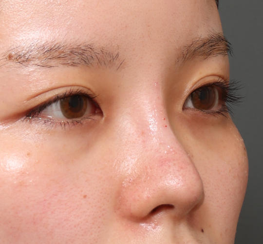 20代女性のヒアルロン酸注射(鼻形成) After 症例写真