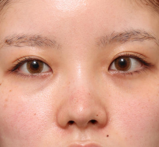20代女性のヒアルロン酸注射(鼻形成) Before 症例写真