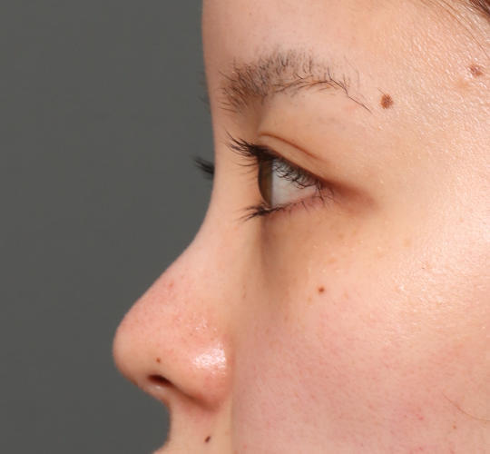 20代女性のヒアルロン酸注射(鼻形成) Before 症例写真