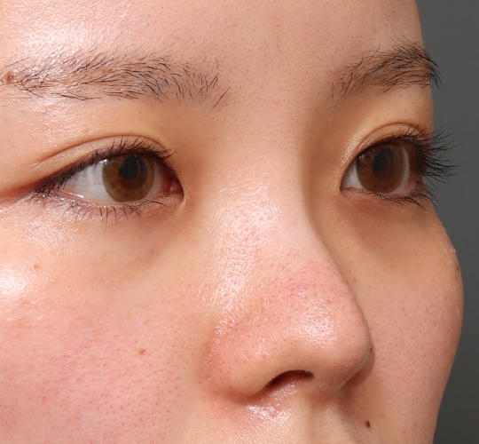 20代女性のヒアルロン酸注射(鼻形成) Before 症例写真