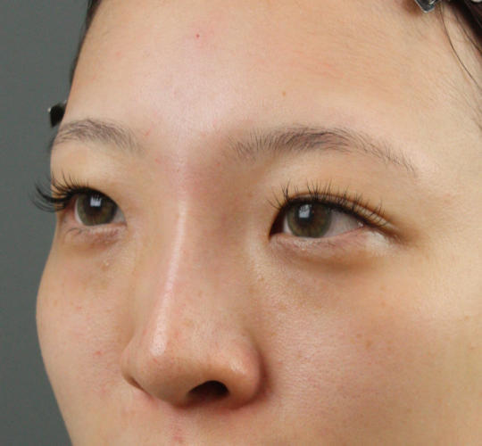 20代女性のヒアルロン酸注射（鼻形成） After 症例写真