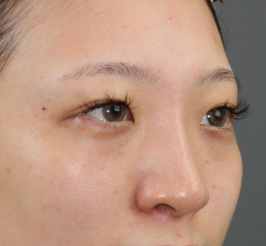 20代女性のヒアルロン酸注射（鼻形成） After 症例写真