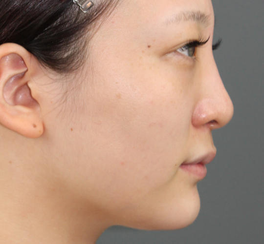 20代女性のヒアルロン酸注射（鼻形成） After 症例写真