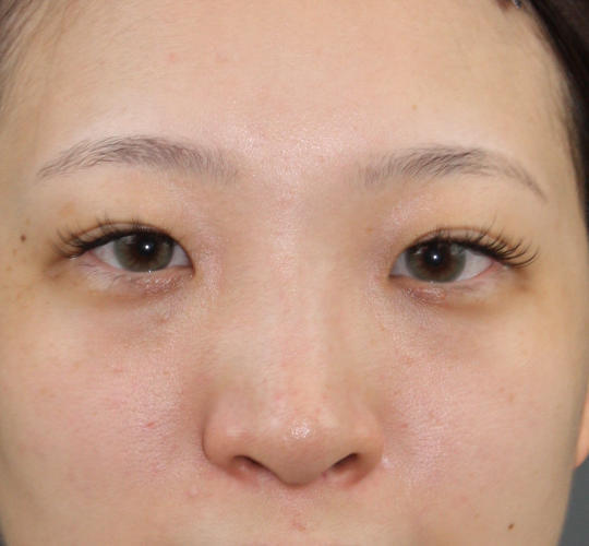 20代女性のヒアルロン酸注射（鼻形成） Before 症例写真