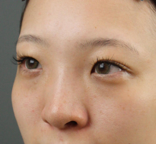 20代女性のヒアルロン酸注射（鼻形成） Before 症例写真