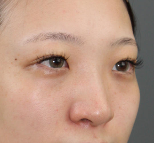 20代女性のヒアルロン酸注射（鼻形成） Before 症例写真