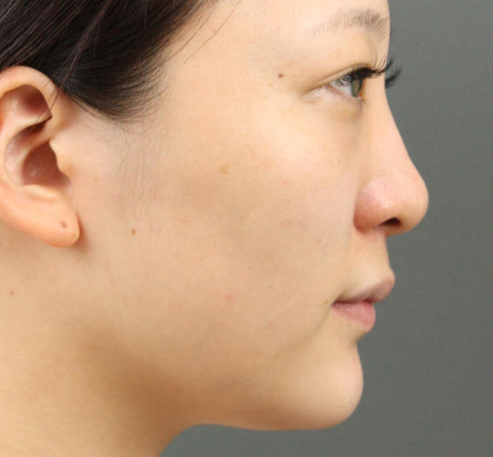 20代女性のヒアルロン酸注射（鼻形成） Before 症例写真