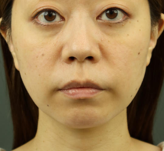 30代女性のヒアルロン酸注射（ゴルゴライン） After 症例写真