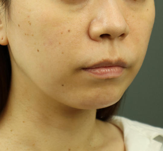 30代女性のヒアルロン酸注射（アゴ形成） After 症例写真