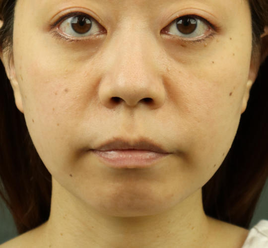 30代女性のヒアルロン酸注射（ゴルゴライン） Before 症例写真
