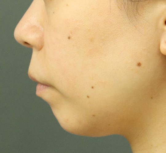 30代女性のヒアルロン酸注射（アゴ形成） Before 症例写真