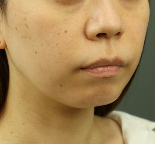 30代女性のヒアルロン酸注射（アゴ形成） Before 症例写真