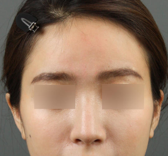 20代女性のヒアルロン酸注射（額） After 症例写真