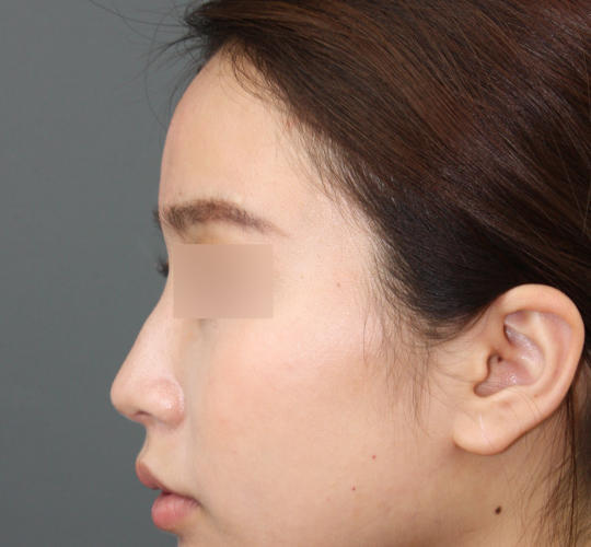 20代女性のヒアルロン酸注射（額） After 症例写真