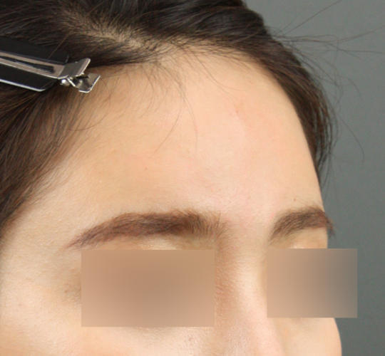 20代女性のヒアルロン酸注射（額） After 症例写真