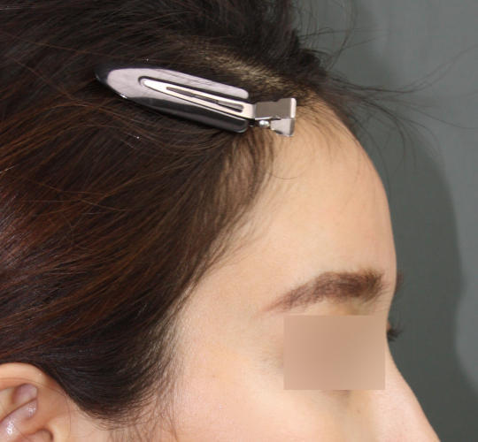 20代女性のヒアルロン酸注射（額） After 症例写真