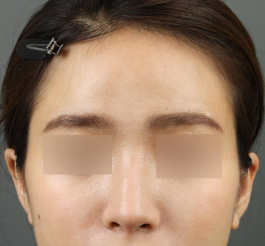 20代女性のヒアルロン酸注射（額） Before 症例写真