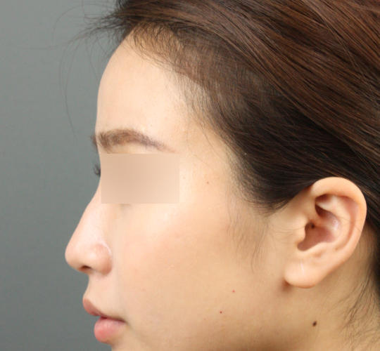 20代女性のヒアルロン酸注射（額） Before 症例写真