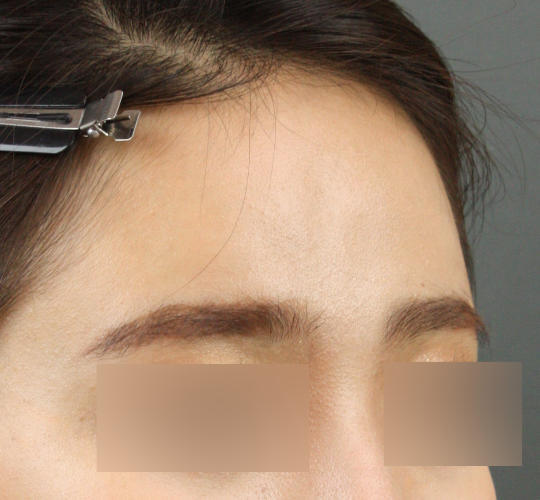 20代女性のヒアルロン酸注射（額） Before 症例写真