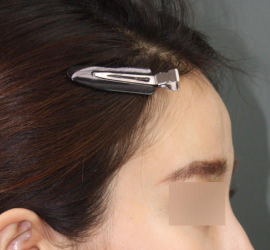 20代女性のヒアルロン酸注射（額） Before 症例写真