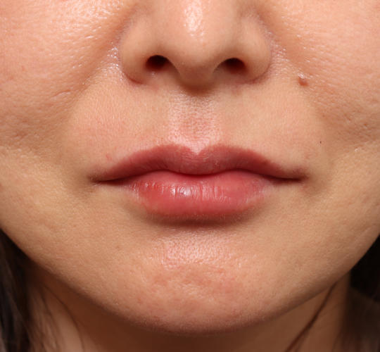 40代女性の唇・口元の整形 After 症例写真