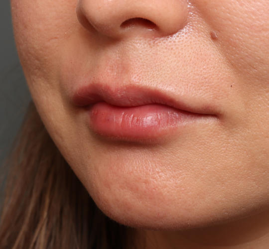 40代女性のヒアルロン酸注射（唇） After 症例写真