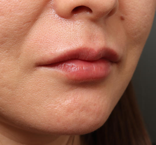 40代女性のヒアルロン酸注射（唇） After 症例写真