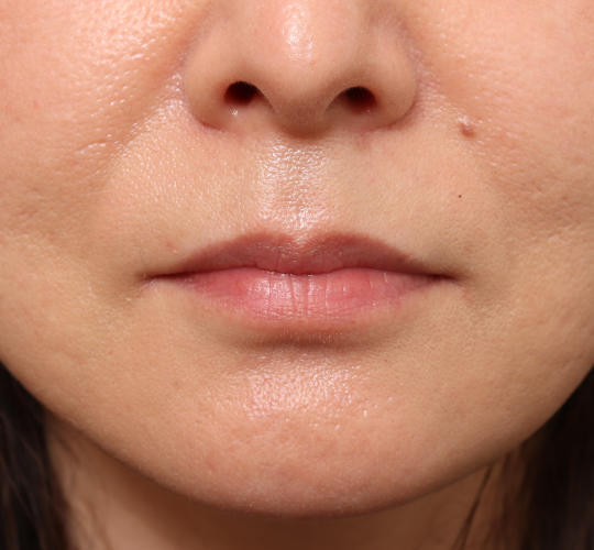 40代女性の唇・口元の整形 Before 症例写真
